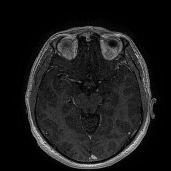 File:Acoustic schwannoma - intracanalicular (Radiopaedia 37247-39024 Axial T1 C+ 110).jpg