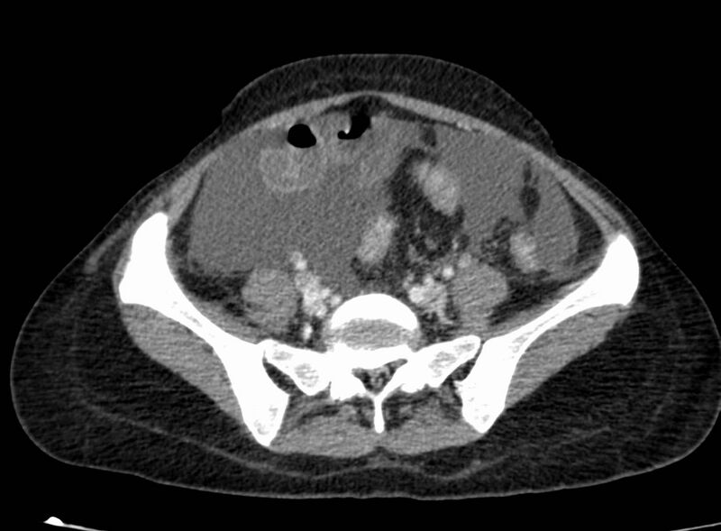 File:Acute Budd-Chiari syndrome (Radiopaedia 60858-68638 Axial C+ portal venous phase 219).jpg