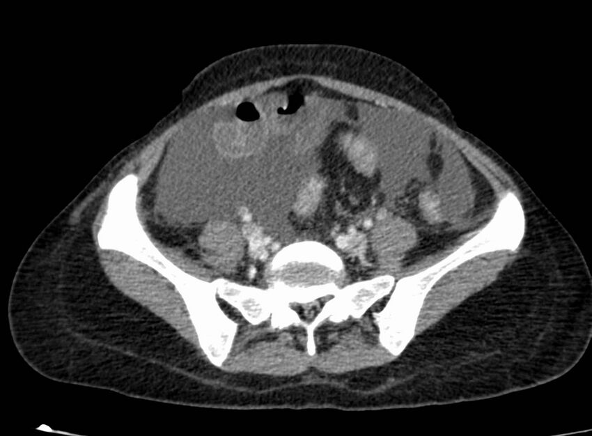 Acute Budd-Chiari syndrome (Radiopaedia 60858-68638 Axial C+ portal venous phase 219).jpg