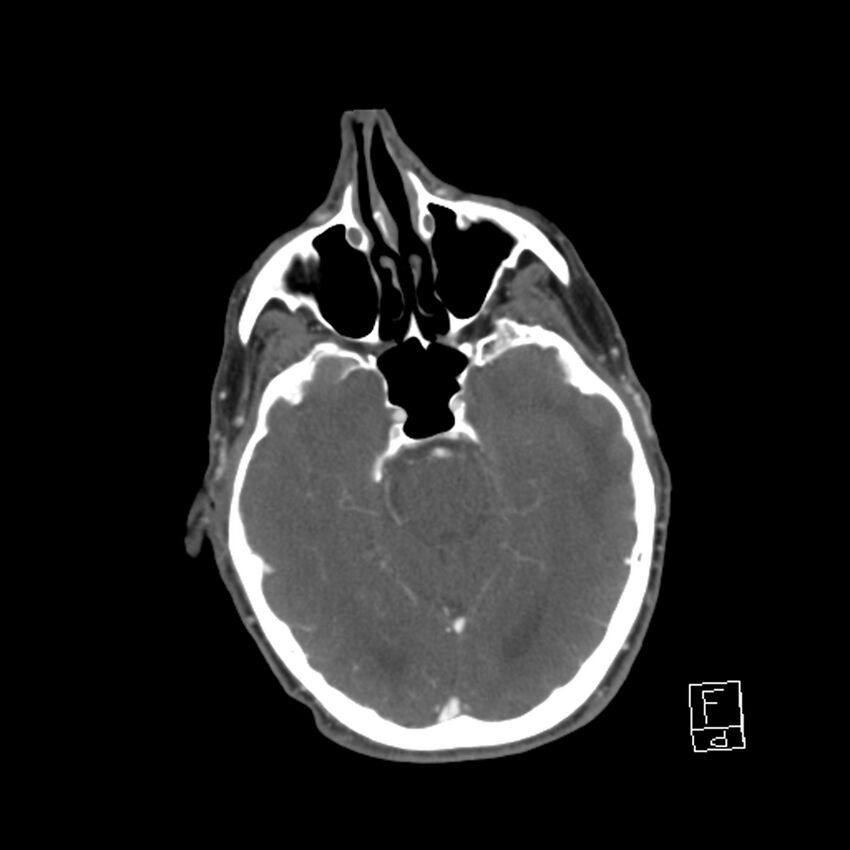 Acute ICA ischemic penumbra due to high-grade CCA stenosis (CT perfusion) (Radiopaedia 72038-82530 Axial C+ arterial phase 12).jpg