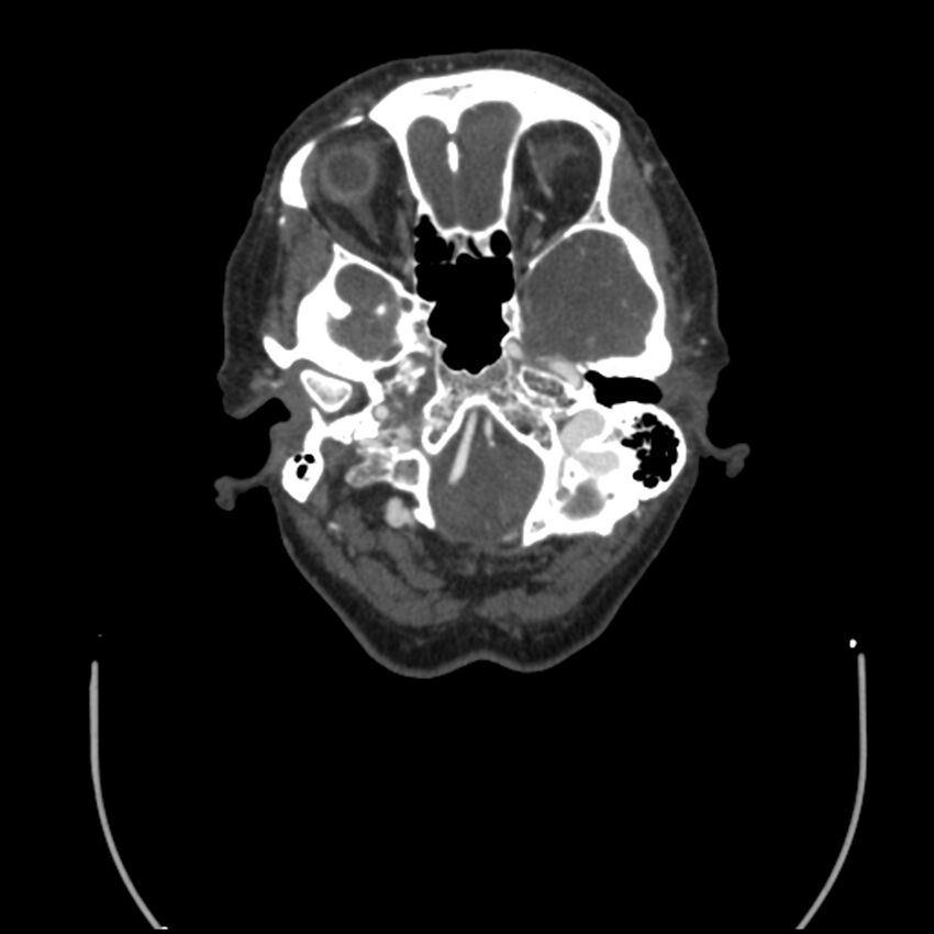 Acute M1 occlusion with ischemic penumbra (CT perfusion) (Radiopaedia 71897-82344 Axial C+ arterial phase thins 133).jpg