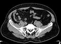 Acute appendicitis (Radiopaedia 13030-13091 Axial non-contrast 30).jpg