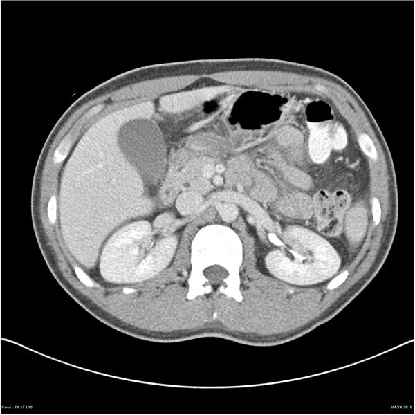 File:Acute appendicitis (Radiopaedia 25364-25615 B 19).jpg