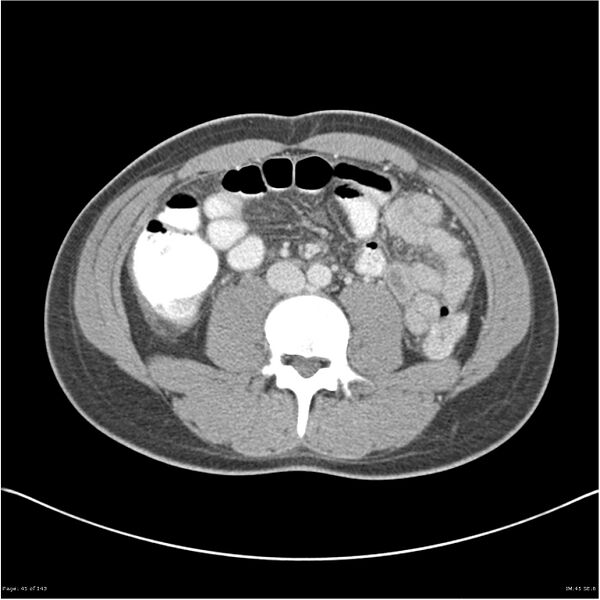 File:Acute appendicitis (Radiopaedia 25364-25615 B 35).jpg