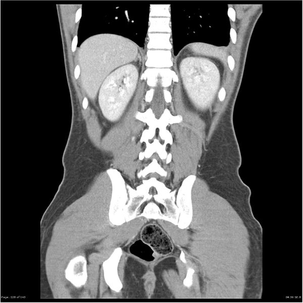 File:Acute appendicitis (Radiopaedia 25364-25615 C+ portal venous phase 25).jpg