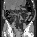 Acute cholecystitis and ureteric colic (Radiopaedia 42330-45444 Coronal prone 49).jpg