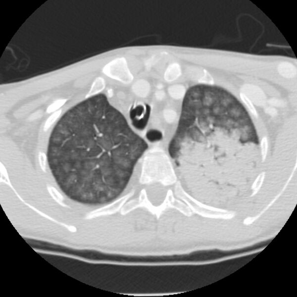 File:Acute diffuse alveolar hemorrhage (Radiopaedia 41323-44158 Axial lung window 9).jpg