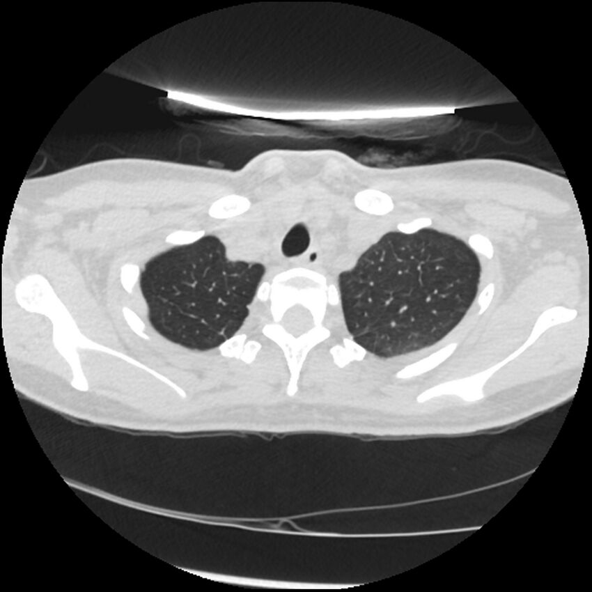 Acute lupus nephritis (Radiopaedia 45832-50107 Axial lung window 11).jpg