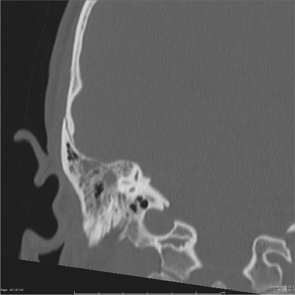 File:Acute otomastoiditis (Radiopaedia 28276-28512 Coronal PTB bone window reformat 38).jpg