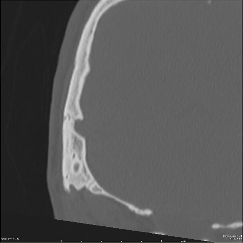 Acute otomastoiditis (Radiopaedia 28276-28512 Coronal PTB bone window reformat 77).jpg