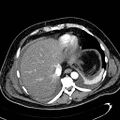 Acute pancreatic necrosis (Radiopaedia 13560-13486 Axial C+ portal venous phase 24).jpg