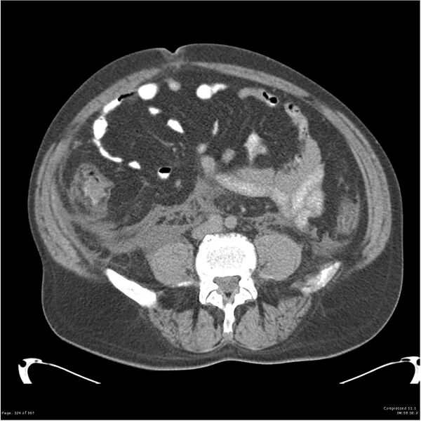 File:Acute pancreatitis (Radiopaedia 19135-19116 Axial non-contrast 38).jpg