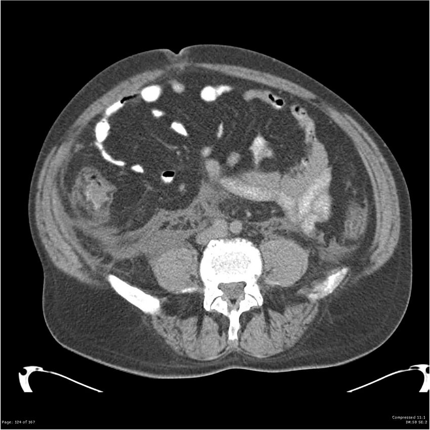 Acute pancreatitis (Radiopaedia 19135-19116 Axial non-contrast 38).jpg
