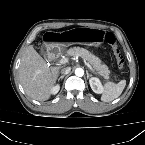 File:Acute pancreatitis (Radiopaedia 22572-22596 Axial C+ arterial phase 23).jpg