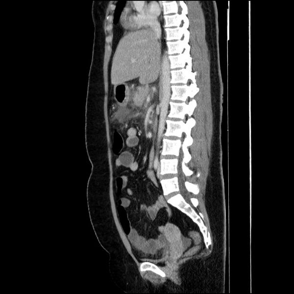 File:Acute pancreatitis (Radiopaedia 69236-79012 Sagittal C+ portal venous phase 53).jpg