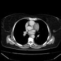 Acute pancreatitis - Balthazar C (Radiopaedia 26569-26714 Axial C+ portal venous phase 6).jpg