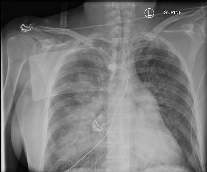 File:Acute pulmonary edema on CT (Radiopaedia 33582-34673 Frontal 1).jpg
