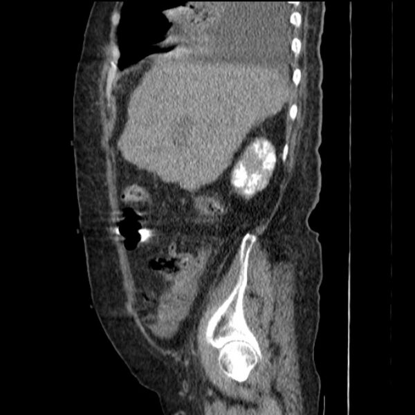 File:Acute tubular necrosis (Radiopaedia 28077-28334 H 25).jpg