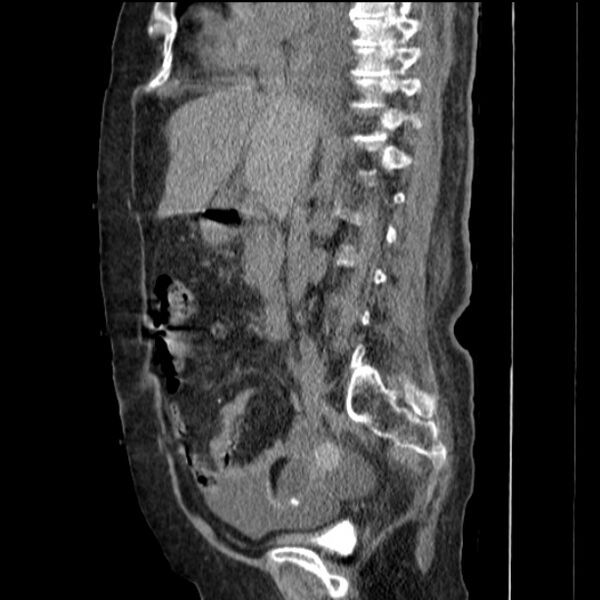 File:Acute tubular necrosis (Radiopaedia 28077-28334 H 40).jpg