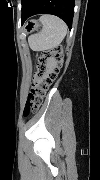 File:Acute uncomplicated appendicitis (Radiopaedia 61374-69304 Sagittal C+ portal venous phase 19).jpg