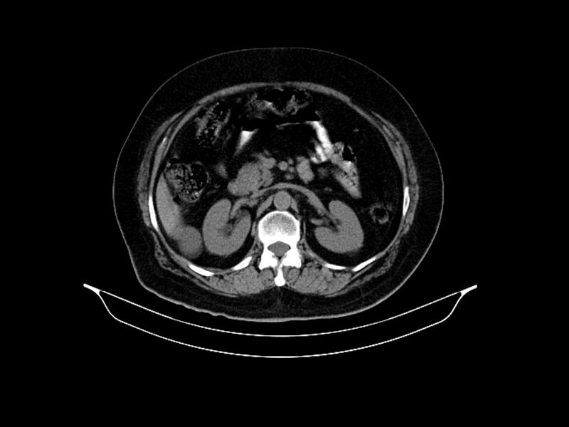File:Adenocarcinoma of pancreas with hepatic metastasis (Radiopaedia 64332-73122 Axial non-contrast 41).jpg