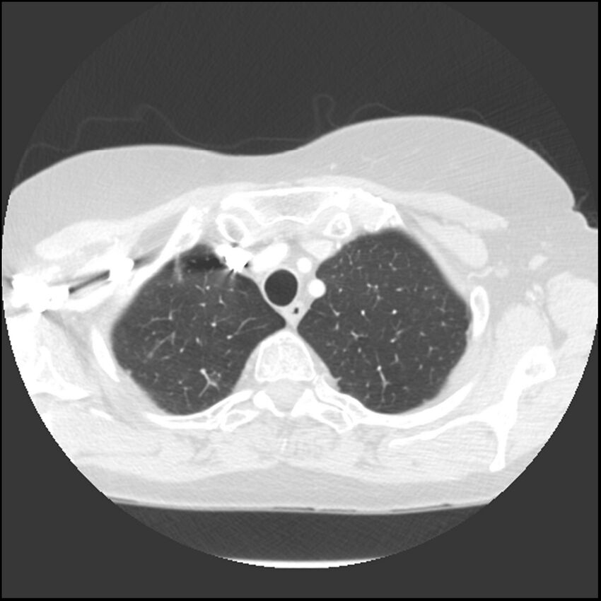 Adenocarcinoma of the lung (Radiopaedia 41015-43755 Axial lung window 19).jpg