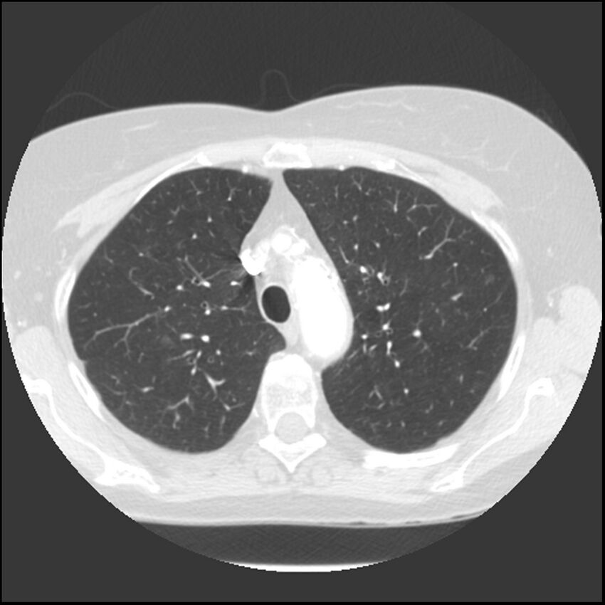 Adenocarcinoma of the lung (Radiopaedia 41015-43755 Axial lung window 33).jpg