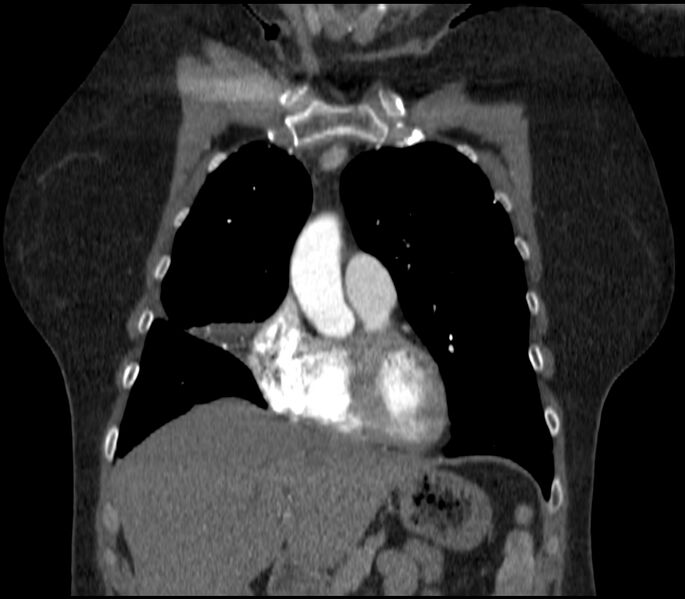 File:Adenocarcinoma of the lung (Radiopaedia 44205-47803 Coronal C+ portal venous phase 25).jpg
