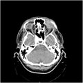 Adenoid cystic carcinoma of the lacrimal gland (Radiopaedia 10999-11416 B 1).jpg