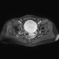 Adenomyoma of the uterus (huge) (Radiopaedia 9870-10438 Axial T1 C+ fat sat 11).jpg