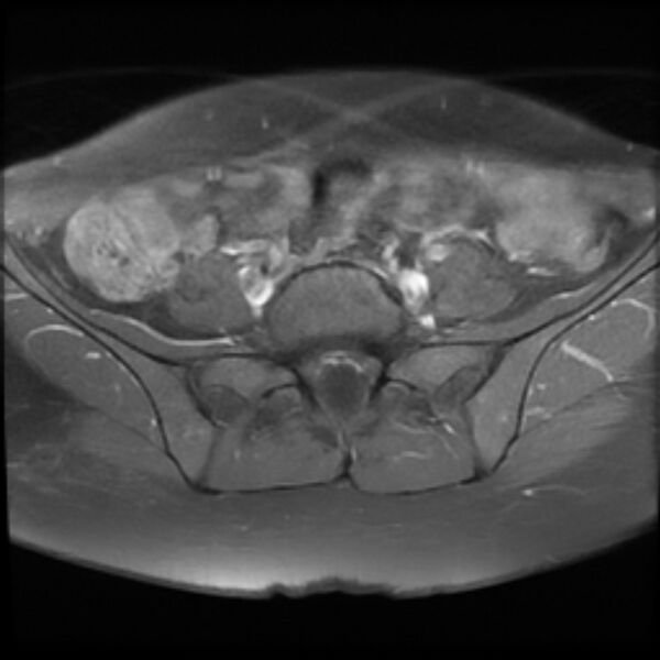 File:Adenomyosis within a septate uterus (Radiopaedia 69963-79981 Axial T1 C+ fat sat 5).jpg
