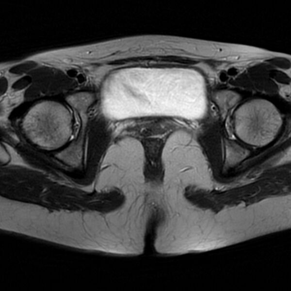 File:Adenomyosis within a septate uterus (Radiopaedia 69963-79981 Axial T2 26).jpg