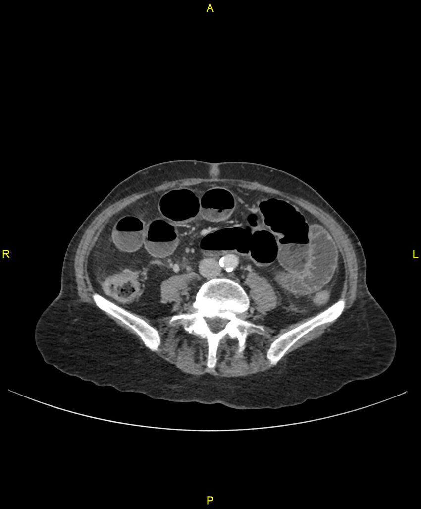 Adhesional small bowel obstruction (Radiopaedia 85402-101024 Axial C+ portal venous phase 171).jpg