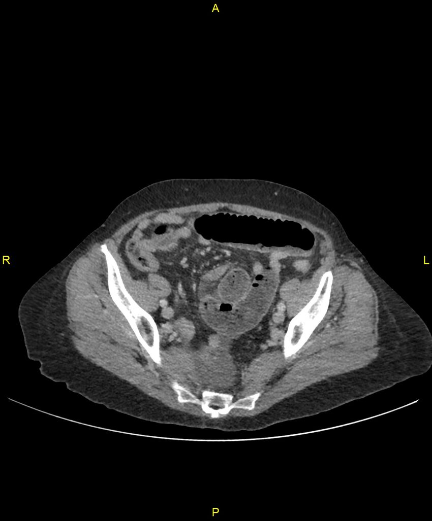 Adhesional small bowel obstruction (Radiopaedia 85402-101024 Axial C+ portal venous phase 228).jpg