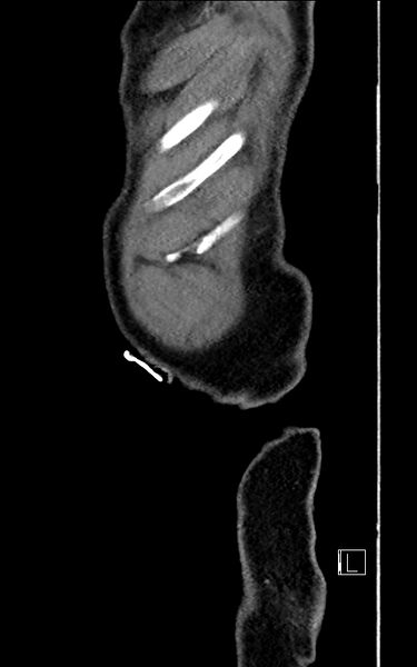 File:Adrenal lymphoma (Radiopaedia 73730-84529 Sagittal C+ portal venous phase 2).jpg