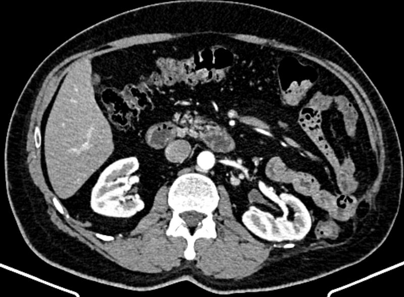 File:Adrenal metastases (Radiopaedia 73082-83791 Axial C+ arterial phase 75).jpg