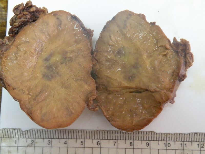 File:Adrenal pheochromocytoma (Radiopaedia 35133-38714 Gross pathology 1).JPG