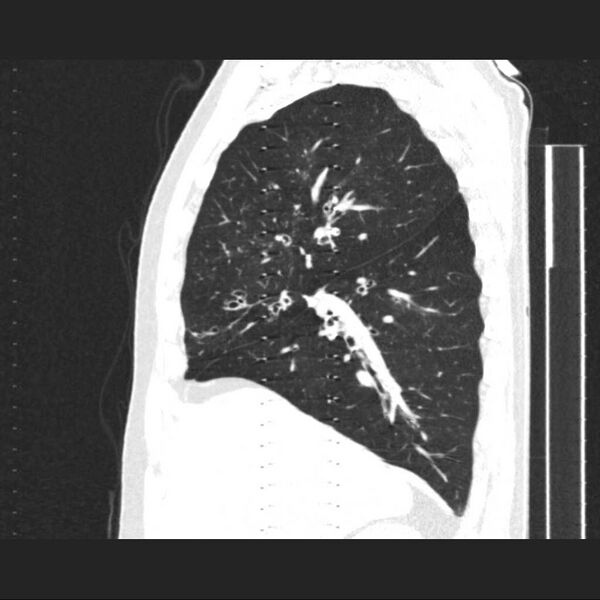 File:Allergic bronchopulmonary aspergillosis (Radiopaedia 21386-21320 Sagittal lung window 13).jpg