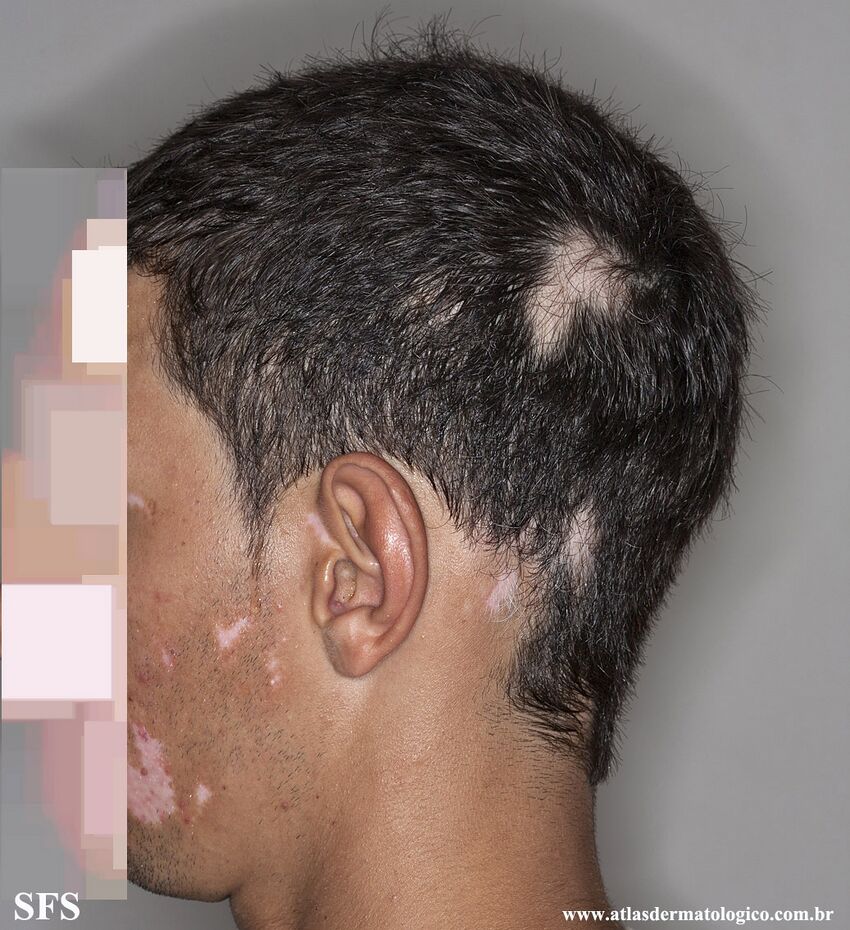 Alopecia Areata And Vitiligo (Dermatology Atlas 1).jpg