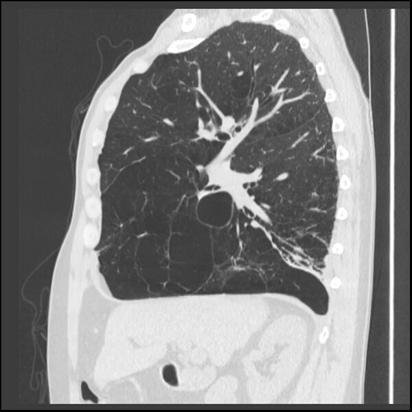 File:Alpha-1-antitrypsin deficiency (Radiopaedia 40993-43722 Sagittal lung window 174).jpg