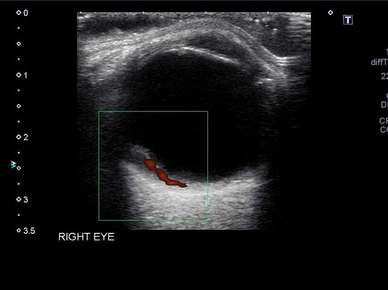 File:Amelanotic retinal melanoma (Radiopaedia 60667-68413 E 1).jpg