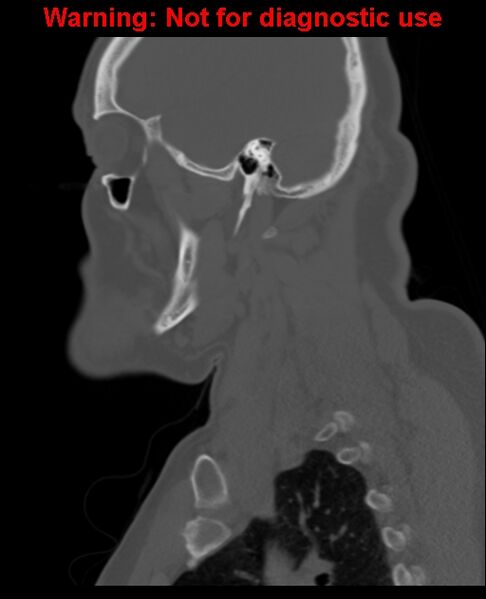 File:Ameloblastoma (Radiopaedia 33126-34164 Sagittal bone window 54).jpg