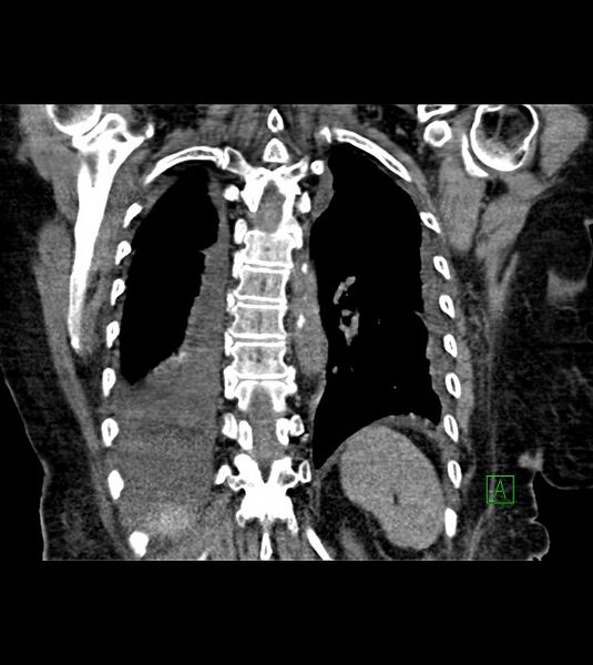 File:Amiodarone deposition in the liver (Radiopaedia 77587-89780 Coronal non-contrast 58).jpg