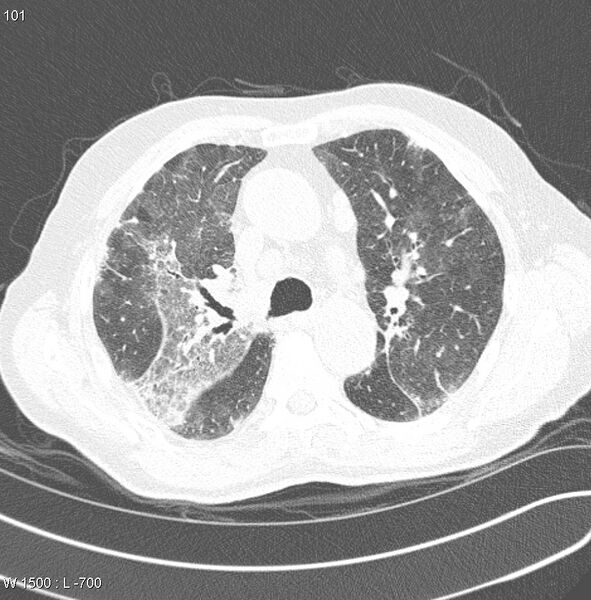 File:Amiodarone lung (Radiopaedia 6539-7851 Axial lung window 10).jpg