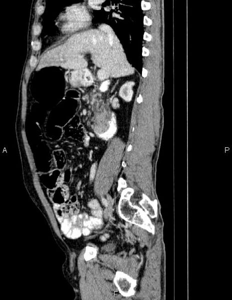 File:Ampullary adenocarcinoma (Radiopaedia 86093-102032 D 36).jpg