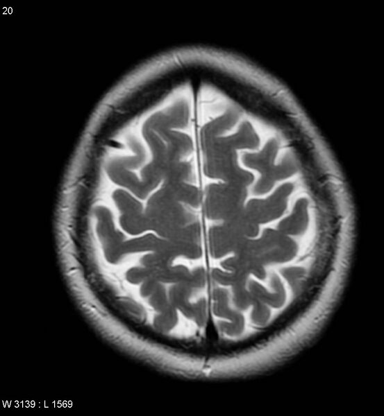 File:Amyotrophic lateral sclerosis (Radiopaedia 5373-7134 Axial T2 20).jpg