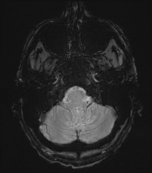 File:Amyotrophic lateral sclerosis (Radiopaedia 87352-103658 Axial SWI 3).jpg