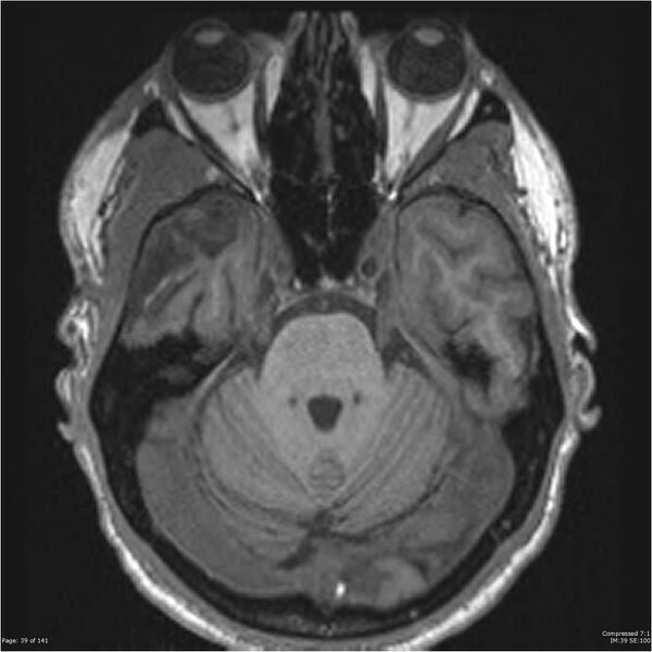 File:Anaplastic meningioma with recurrence (Radiopaedia 34452-35788 Axial T1 37).jpg