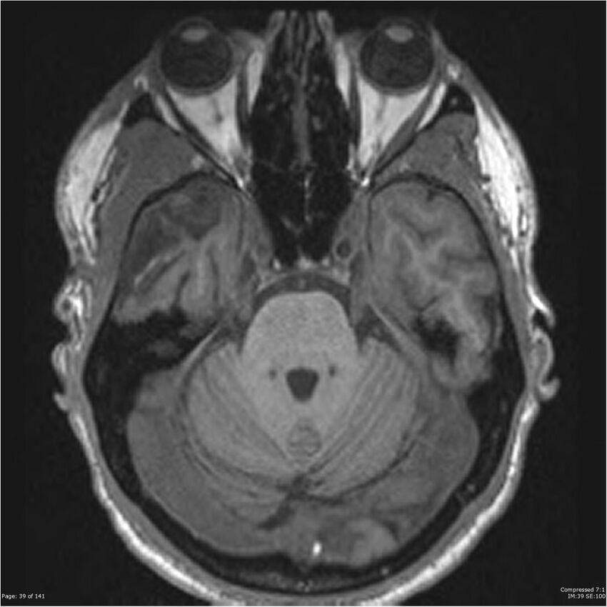 Anaplastic meningioma with recurrence (Radiopaedia 34452-35788 Axial T1 37).jpg