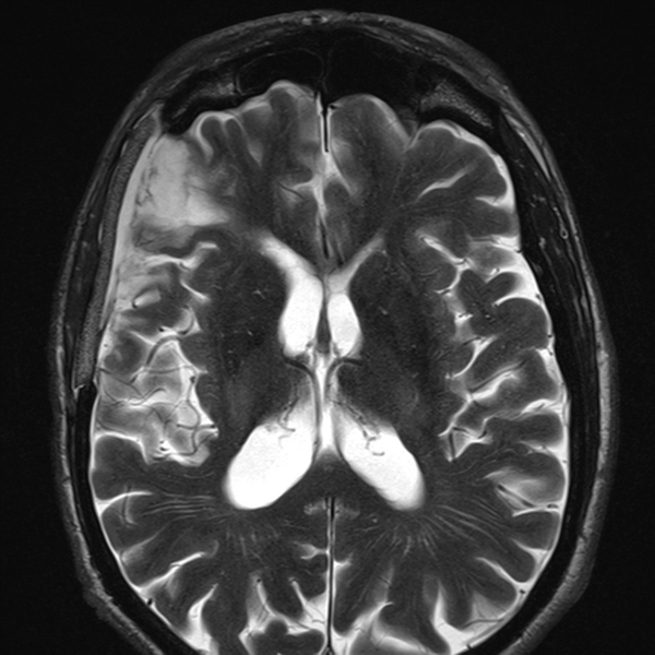 File:Anaplastic meningioma with recurrence (Radiopaedia 34452-35788 Axial T2 14).png